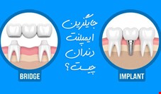 بهترین جایگزین ایمپلنت دندان چیست؟